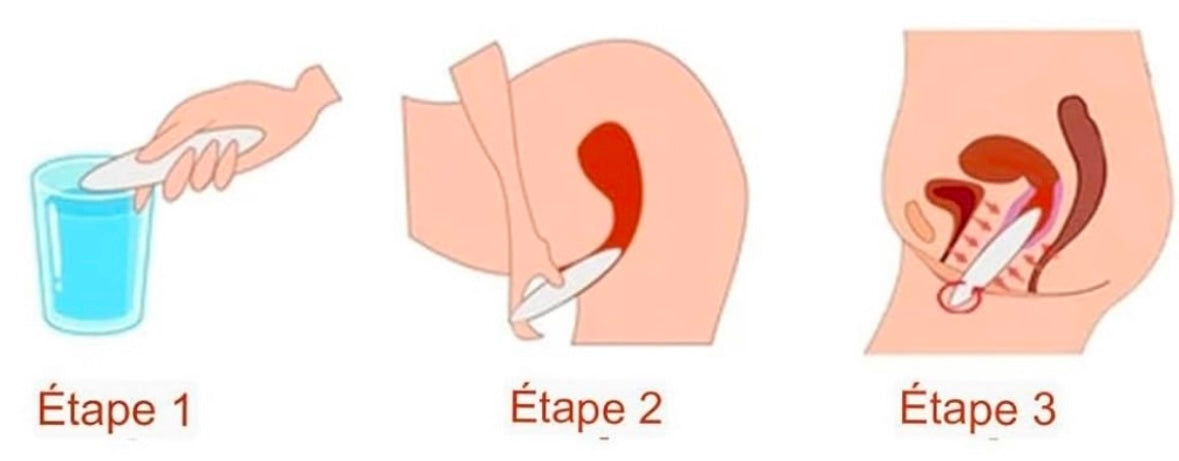 Craie vaginale